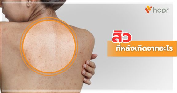 สิวที่หลังเกิดจากอะไร