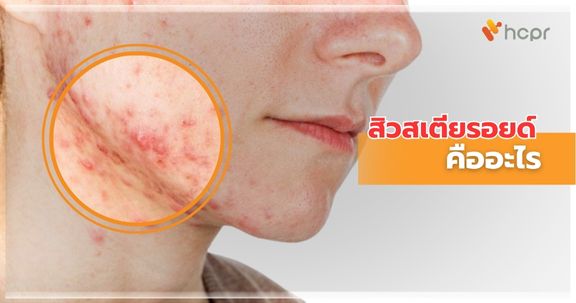 สิวสเตียรอยด์ (Steroid Acne) คืออะไร