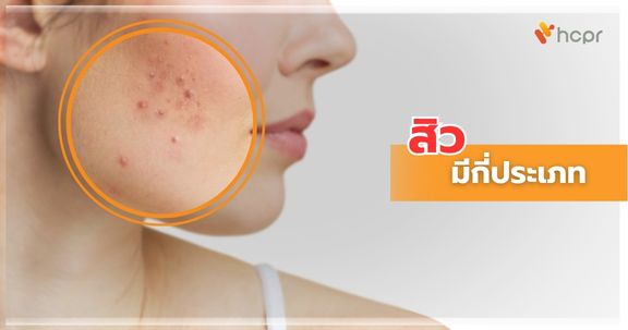 สิว มีกี่ประเภท